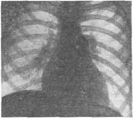 Рис. Расширение артериальных сосудов корней легких при синдроме Айерсы
