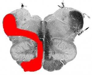 Синдром Бабинского-Нажотта (срез)