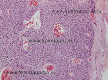 Микропрепарат опухоли Барре - Массона