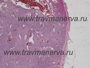 Микропрепарат опухоли Барре - Массона