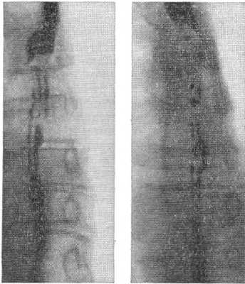 Синдром Баршоня — Тешендорфа: изменчивость рентгенологической картины пищевода (снимки сделаны с интервалом в 15 мин.).