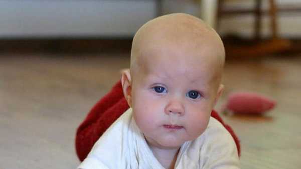 синдром горнера у детей