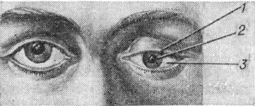 Глаз больного с синдромом Бернара — Горнера (левый глаз); 1 — псевдоптоз; 2— миоз; 3 — энофтальм.