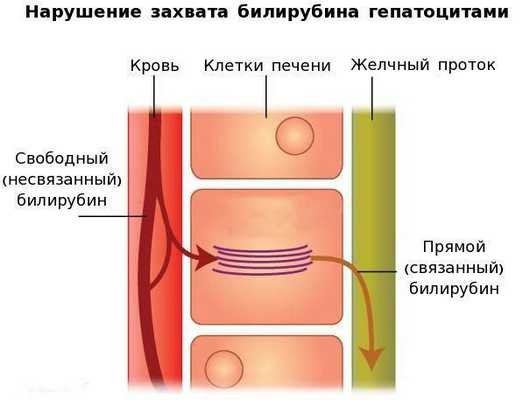Нарушение захвата билирубина гепатоцитами