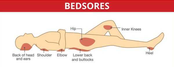 Зоны образования пролежней