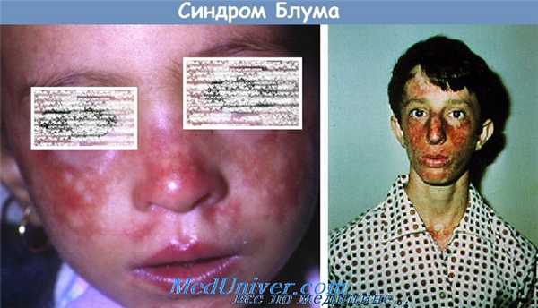 синдром Блума