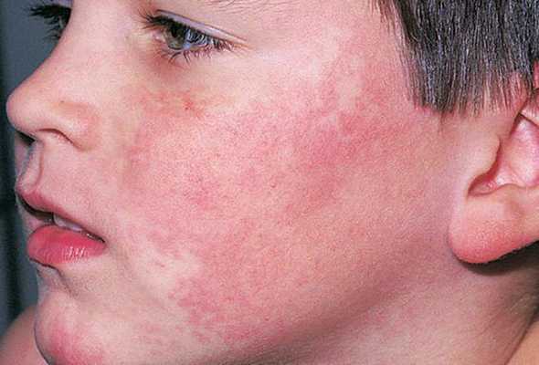 Синдром Блума