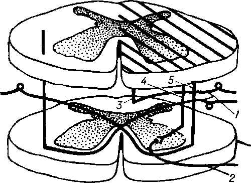 Рис. 2. Схема поражения спинного мозга при синдроме Броун-Секара (пораженный сегмент заштрихован): 1 — задний корешок; 2 — передний корешок; 3 — боковой пирамидный путь; 4 — пути задних столбов; 5 — спино-таламический путь.