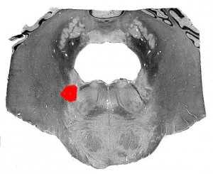 Синдром Боннье (срез)