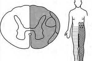 sindrom broun sekara