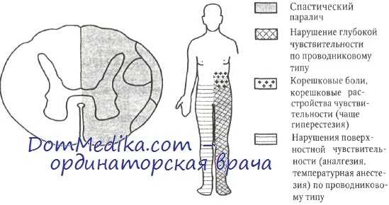 sindrom polovinnogo poragenia spinnogo mozga