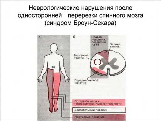 Синдром Броун-Секара