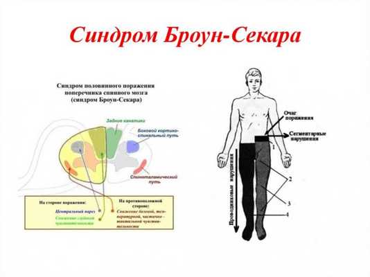 Синдром Броун-Секара