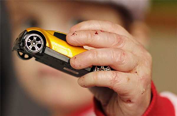 Буллезный эпидермолиз