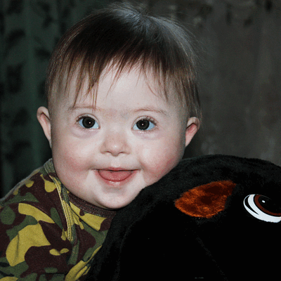 Фотогалерея детей с синдромом Дауна