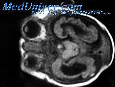 синдром денди-уокера