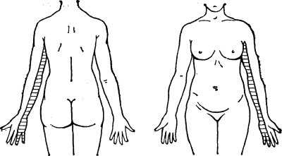 Схема зон расстройства чувствительности на внутренних поверхностях плеча, предплечья и кисти (на рисунке заштриховано), соответствующих иннервации VIII шейного и I грудного спинномозговых нервов при параличе Дежерин-Клюмпке.