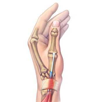 Что такое болезнь де Кервена