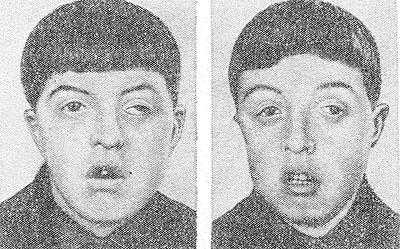 Рис. 2. Однояйцовые близнецы 13 лет с черепно-лицевым дизостозом (синдром Крузона). Характерны широко расставленные глаза, выражено косоглазие, гипоплазия верхней челюсти.