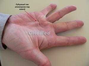 операция контрактура дюпюитрена