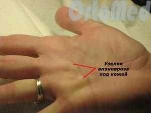 Контрактура Дюпюитрена лечение