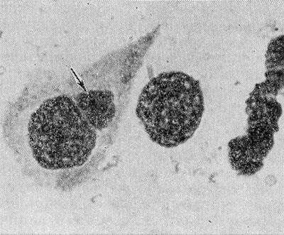 Рис. 1. Инфицированная клетка (слева) с цитоплазматическим включением (указано стрелкой), содержащим возбудителя пахового лимфогранулематоза (в световом микроскопе). Окраска по Романовскому— Гимзе; х 2000.