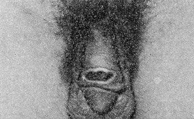 Рис. 3. Язва на крайней плоти полового члена при паховом лимфогранулематозе