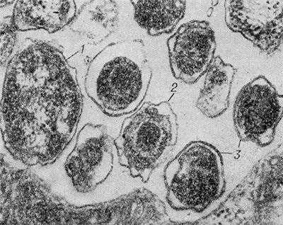 Рис. 2. Электронограмма морфологических структур возбудителя пахового лимфогранулематоза в цитоплазматическом включении: 1 — инициальное, 2 — промежуточное, 3 — элементарные тельца; х 90 000.