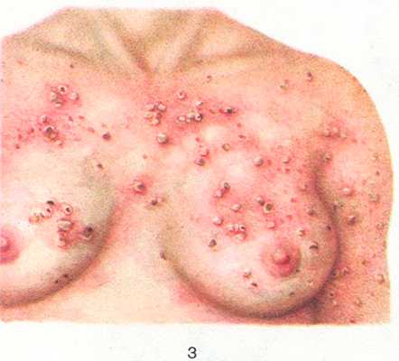 Рис. 3. Герпетиформный дерматит (Дюринга болезнь): сгруппированная полиморфная сыпь (эритема, везикулы, папулы).