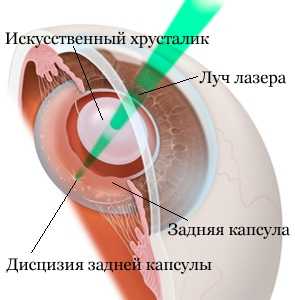 Удаление вторичной катаракты лазером