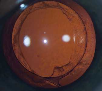 После вторичной катаракты