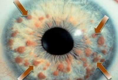 Узелки Лиша