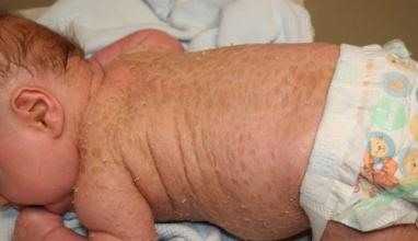 Нейрофиброматоз у ребенка