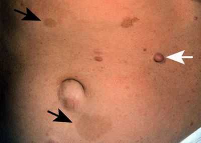 Нейрофибромы и пигментные пятна