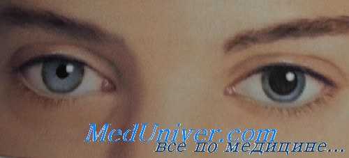 синдром Эйди