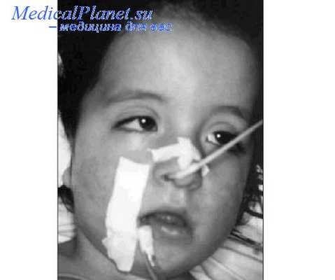 паралич у ребенка