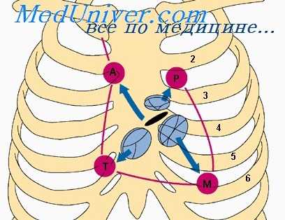 синдром эйзенменгера