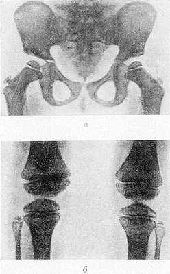 Рис. Рентгенограммы таза (а) и коленных суставов (б) ребенка с болезнью Фэрбанка (прямая проекция): эпифизы бедренных и берцовых костей уменьшены в размерах, высота их снижена, суставные поверхности неровные.