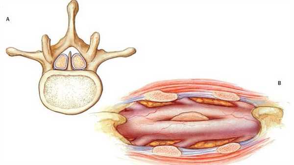 Диастематомиелия