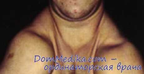 ключичнокраниальная дисплазия