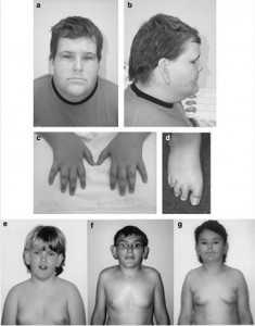 Бёрьесона-Форсмана-Лемана синдром_внешний вид