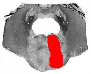 Синдром Фовилля (срез)