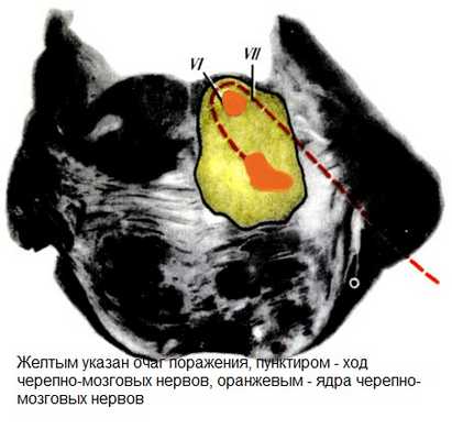 Синдром Фовилля