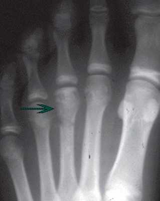 снимок рентгена болезни Келлера