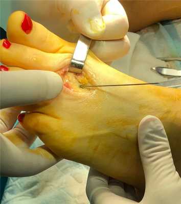 операция на косточке