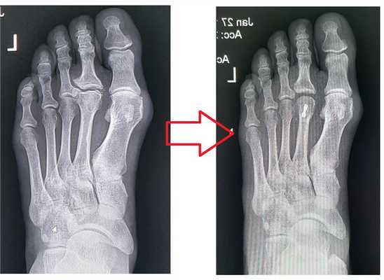 болят пальцы ног