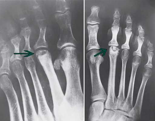 остеохондропатия головки плюсневой кости