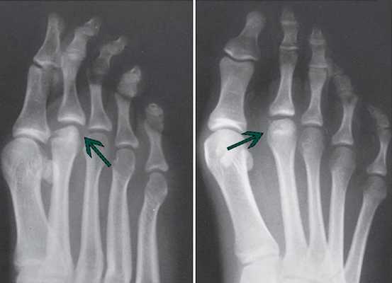 рентген болезнь-келлера