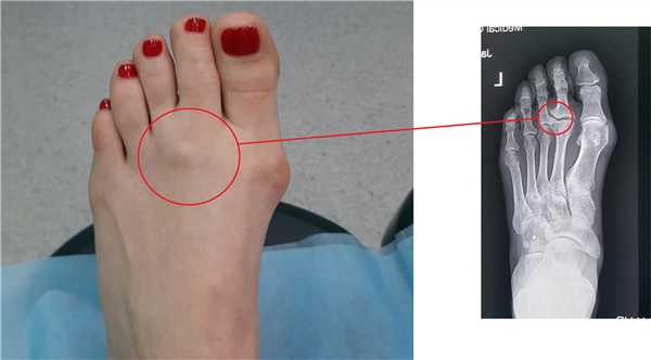 косточки на пальцах ног 