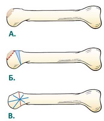 остеотомия при болезни Келлера